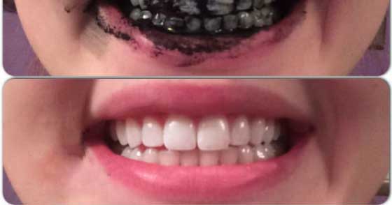خمیر دندان زغالی اصل برای سفید کردن دندان